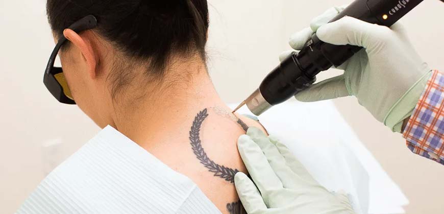 Laser tattoo removal cost in Delhi | Dr Syed